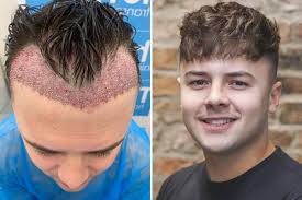 Choosing the Best Hair Transplant Clinic in Turkey: What to Look For